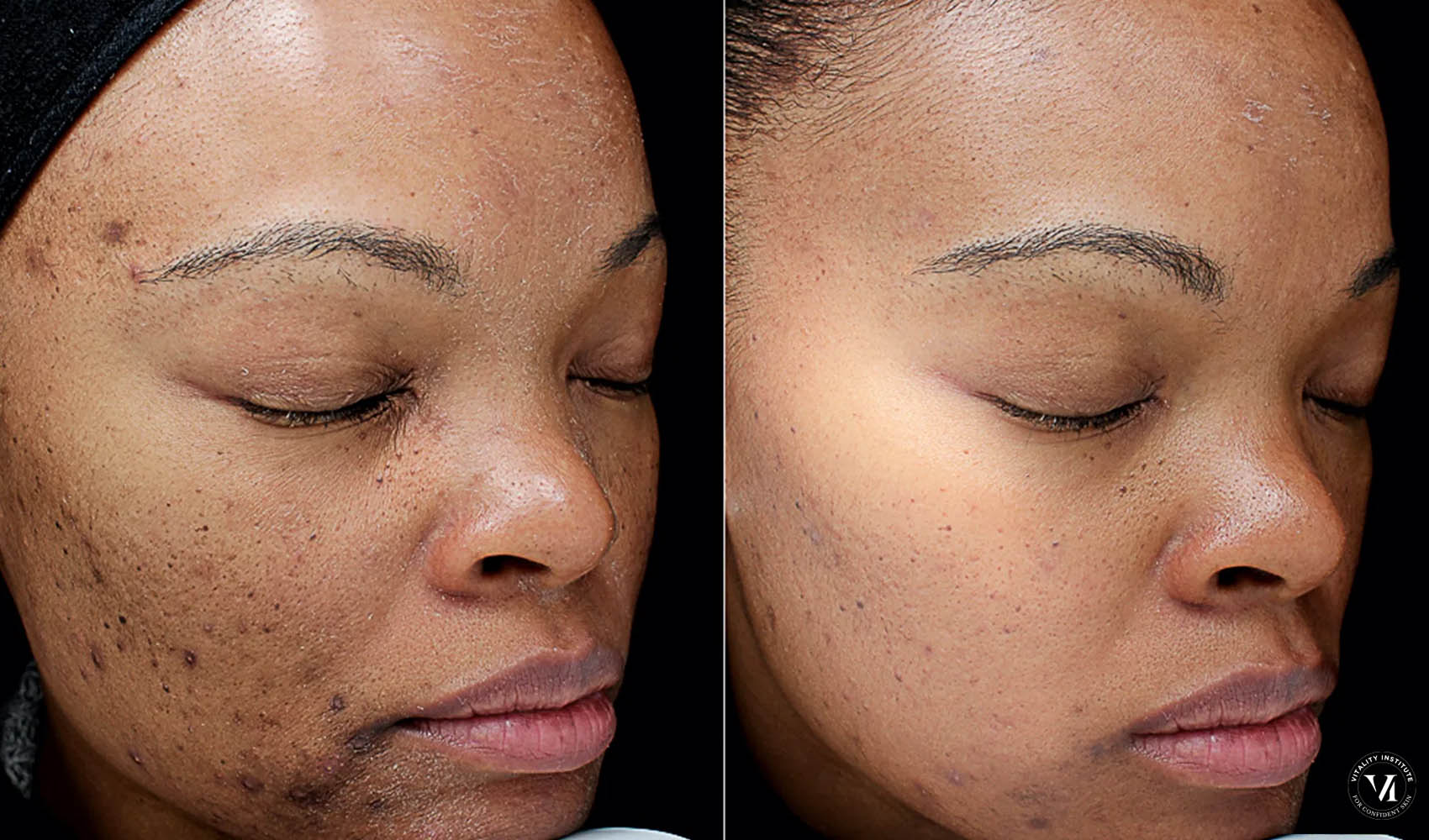 VIP Peel.jpg.webp C3 Wellness Spa VIP Peel