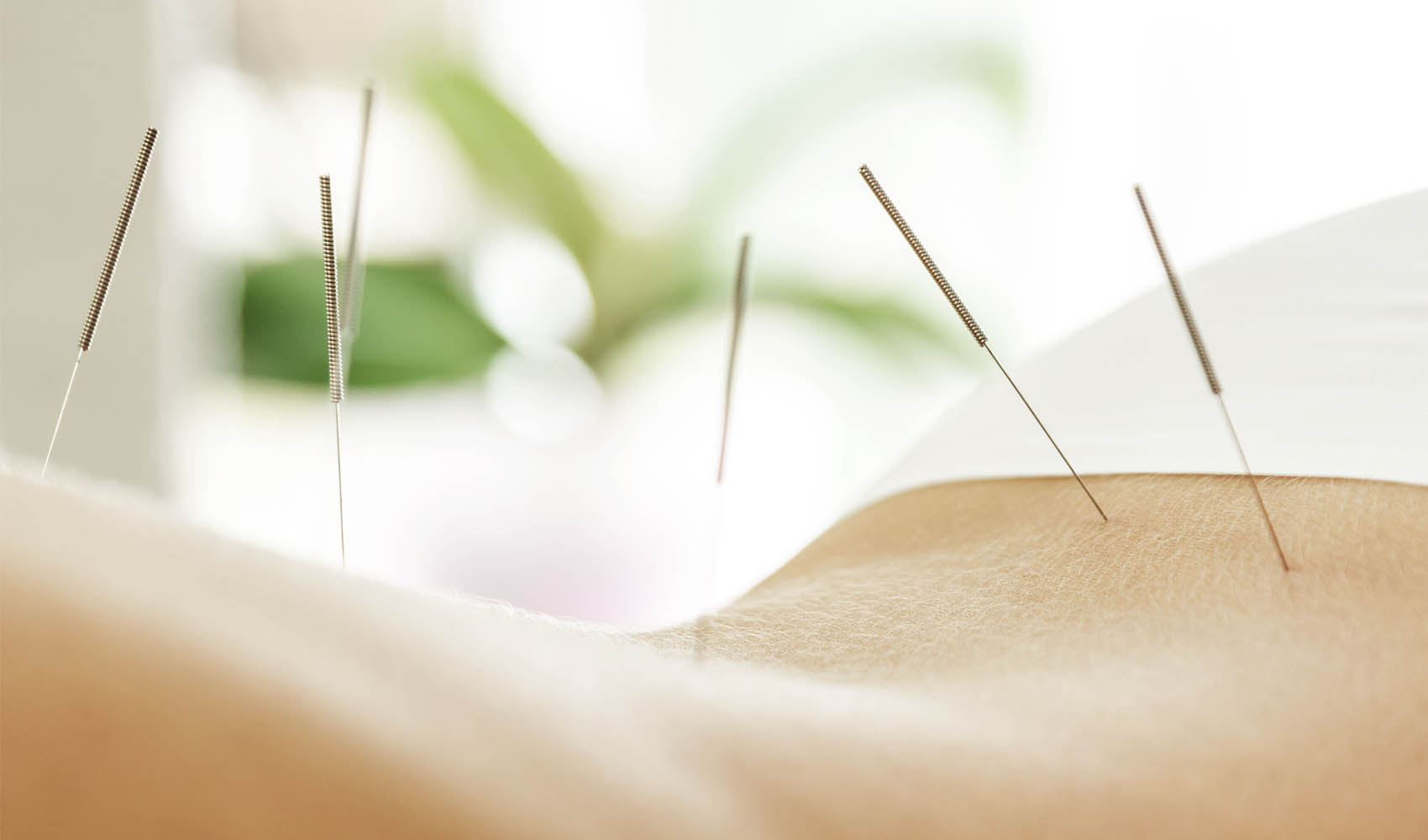 Web Optimized_0000_Acupuncture.jpg C3 Wellness Spa Acupuncture