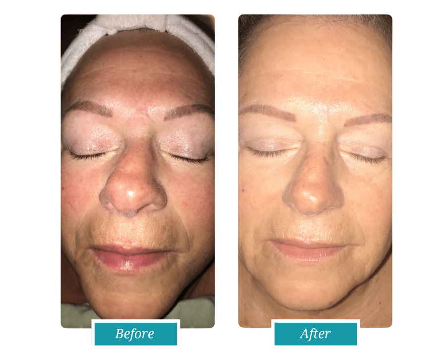 Med Spa Facial Before & After (4) med spa facial before & after results